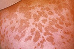 valley-fever-fungal-infection