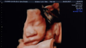 Doctors perform first-ever life saving brain surgery on baby in womb