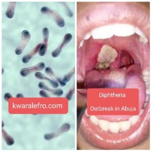 diphtheria outbreak Abuja causes symptoms treatment